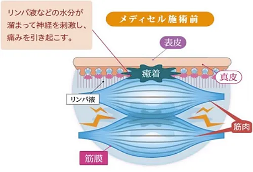 痛みを引き起こす、筋肉の癒着。